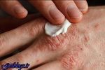 باکتری های خوب پوست سلاحی امیدبخش در مقابله با اگزما